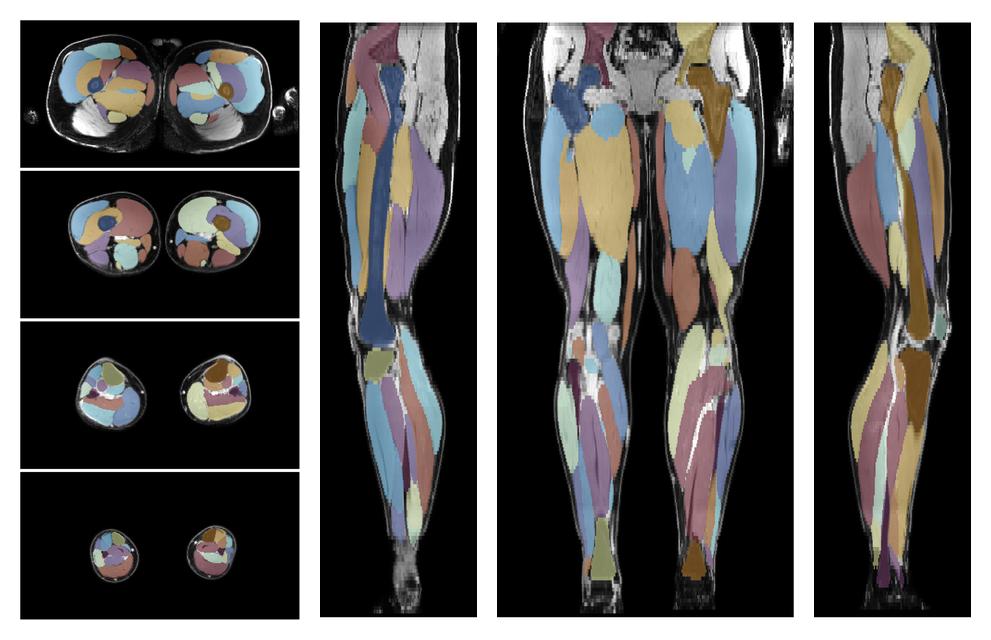 Overlay of automated muscle segmentation labels on dixon water image.